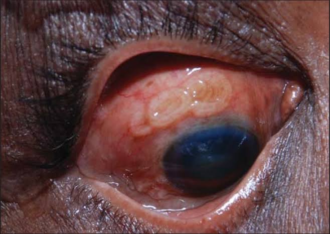Identify The Anterior Segment Condition