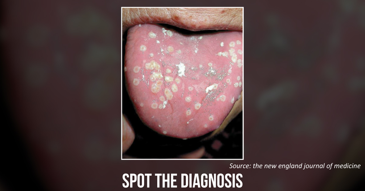 An Elderly with White Tongue Eruptions