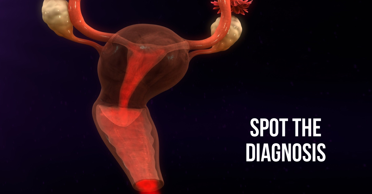 Unexplained Vaginal Bleeding In a Menopausal Woman