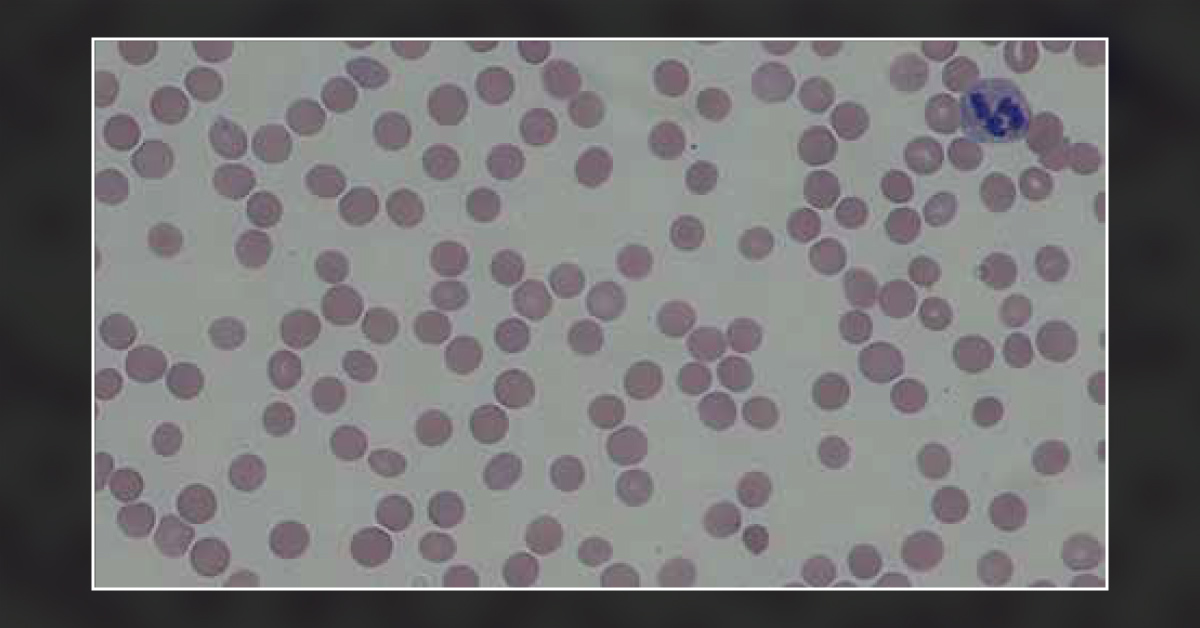 Identify the Cause of Acute Thrombocytopenia in This Patient