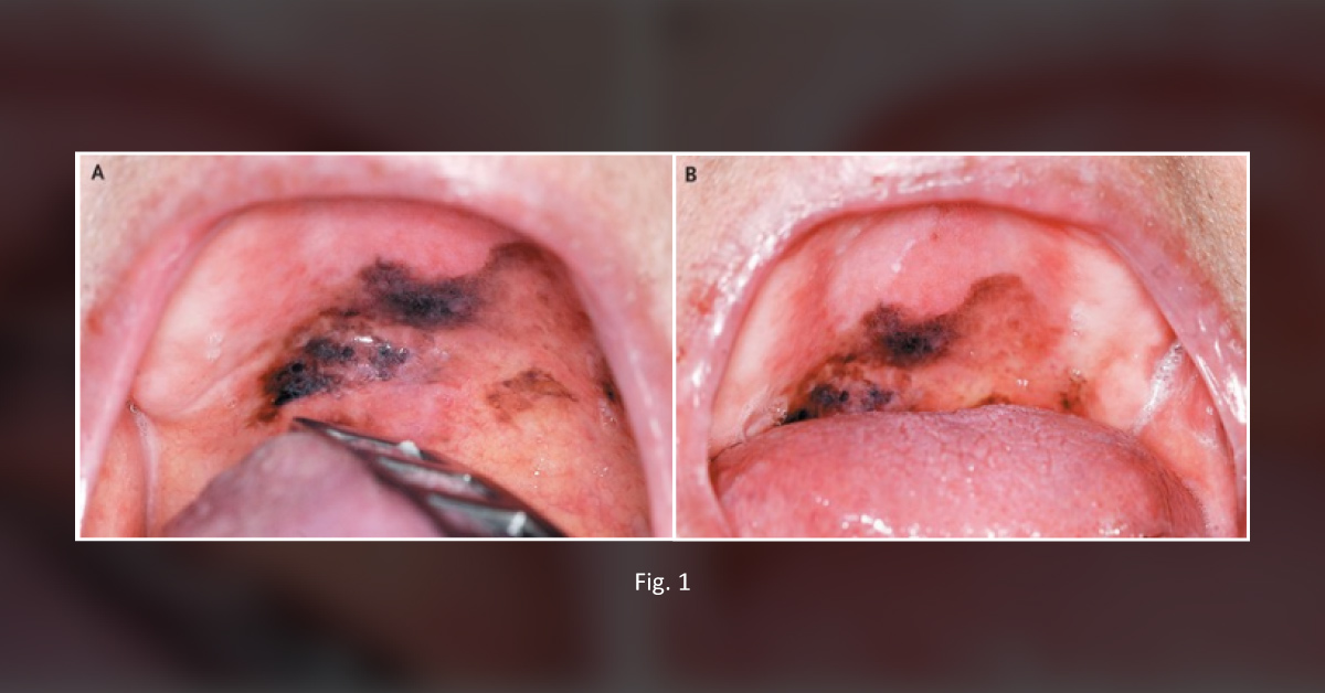 Case of a Geriatric Patient with an Unusual Palate Discoloration