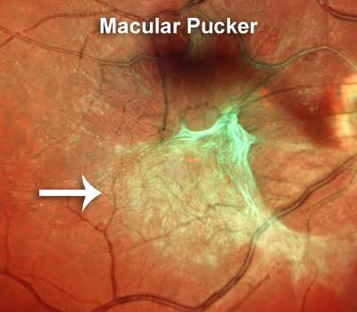Spot The Diagnosis Of Given Image