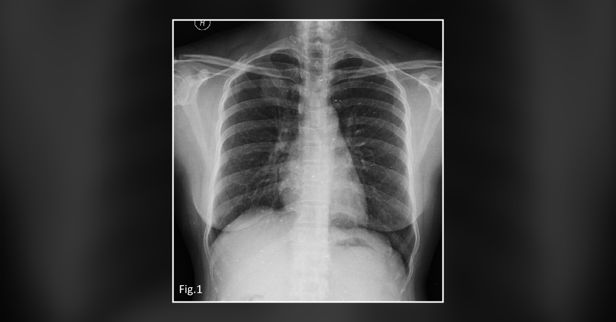 A Middle-aged Woman with Persistent Cough