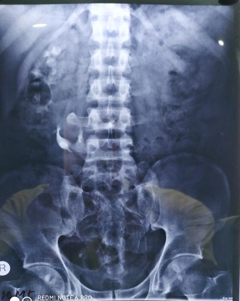 Zero Tolerance Against Pain Abdomen