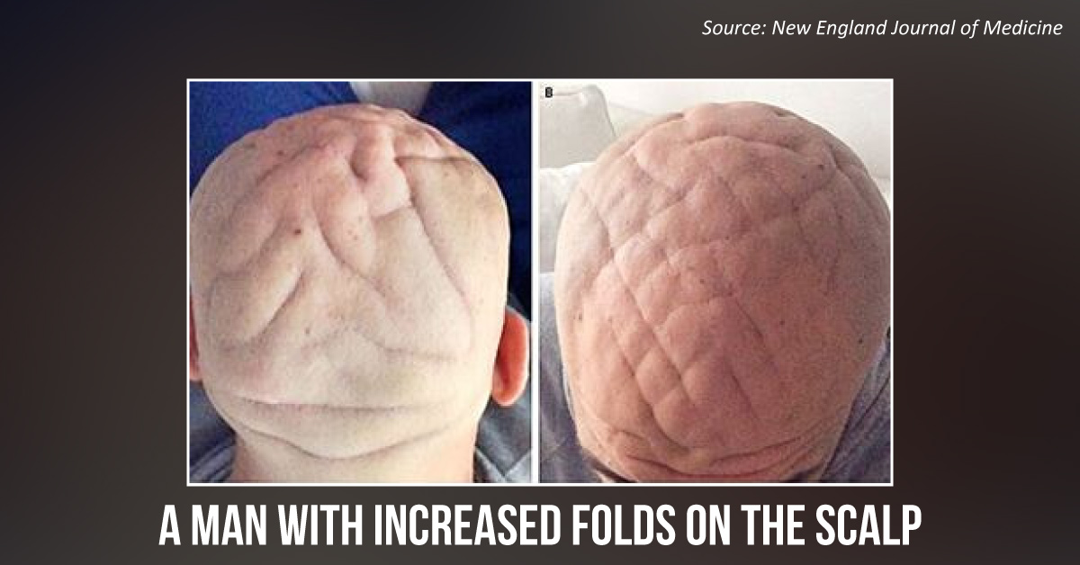 A Case of Increasing Skin Folds on the Scalp