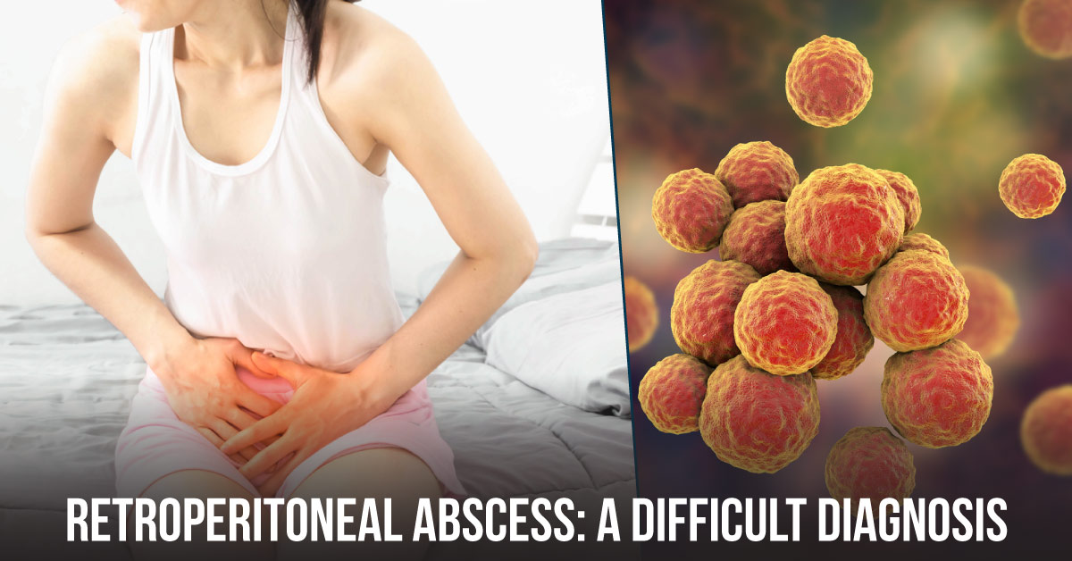 Management of A Retroperitoneal Abscess With Pyrexia Of Unknown Origin