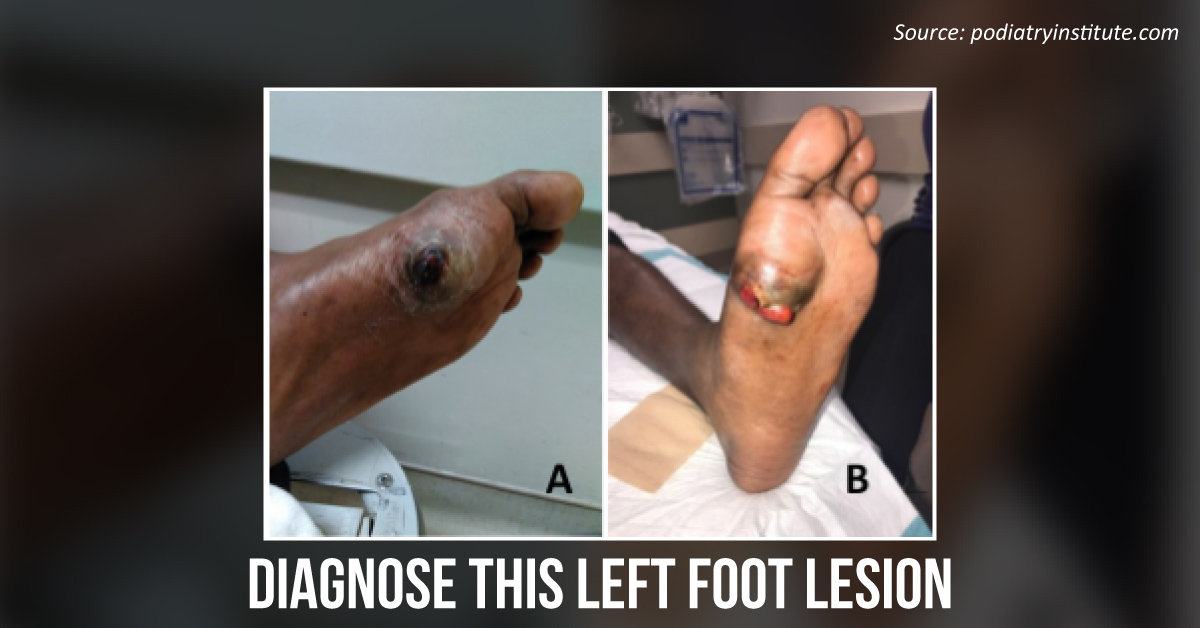 Identify the Nodule in the Plantar Region of the Foot
