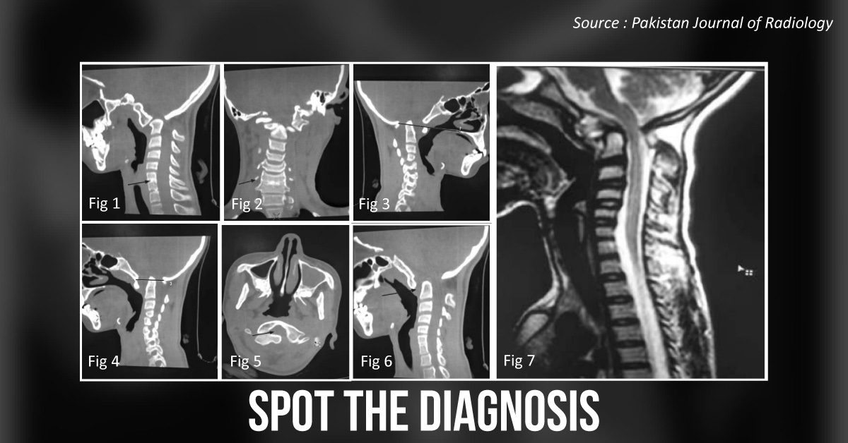 A Teenager With A Complaint Of Neck Stiffness