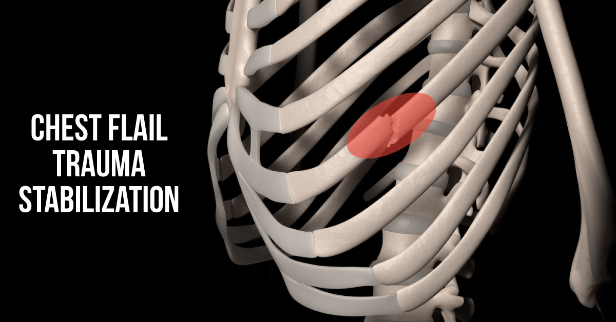 A Case Series Investigation on Flail Rib Trauma and Fixation