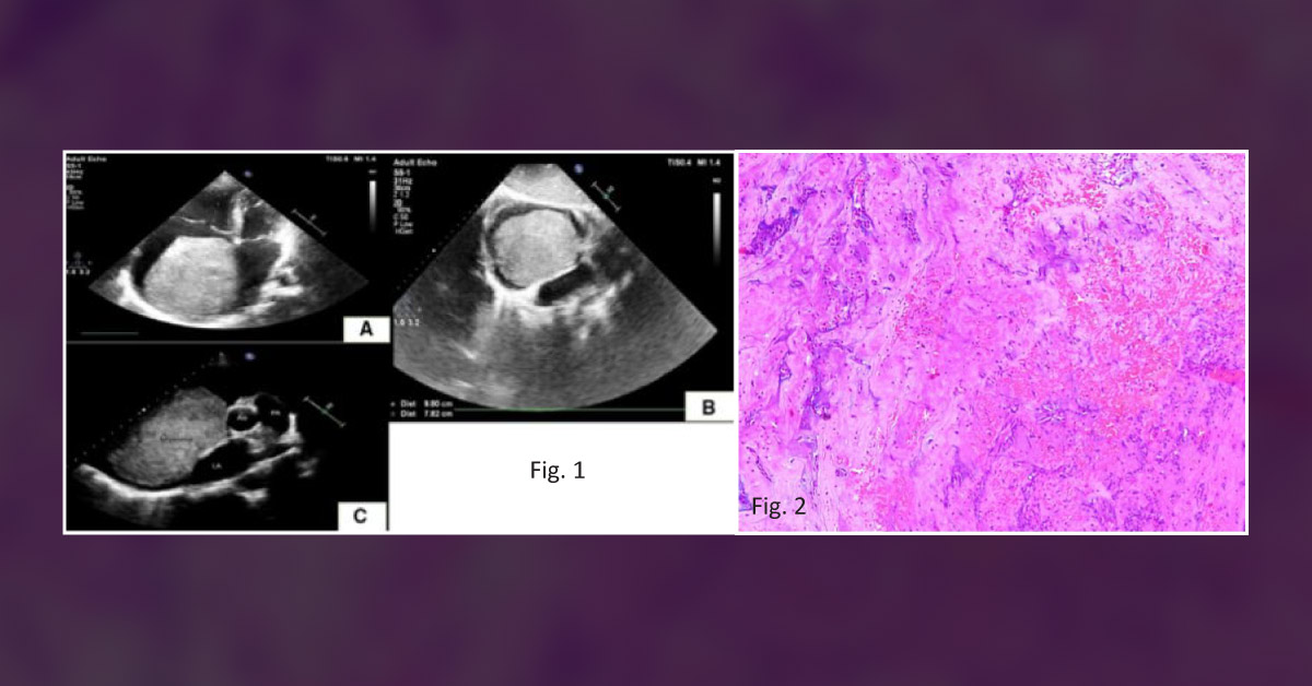A Laborer with Atrial Tumor Manifested as Heart Failure