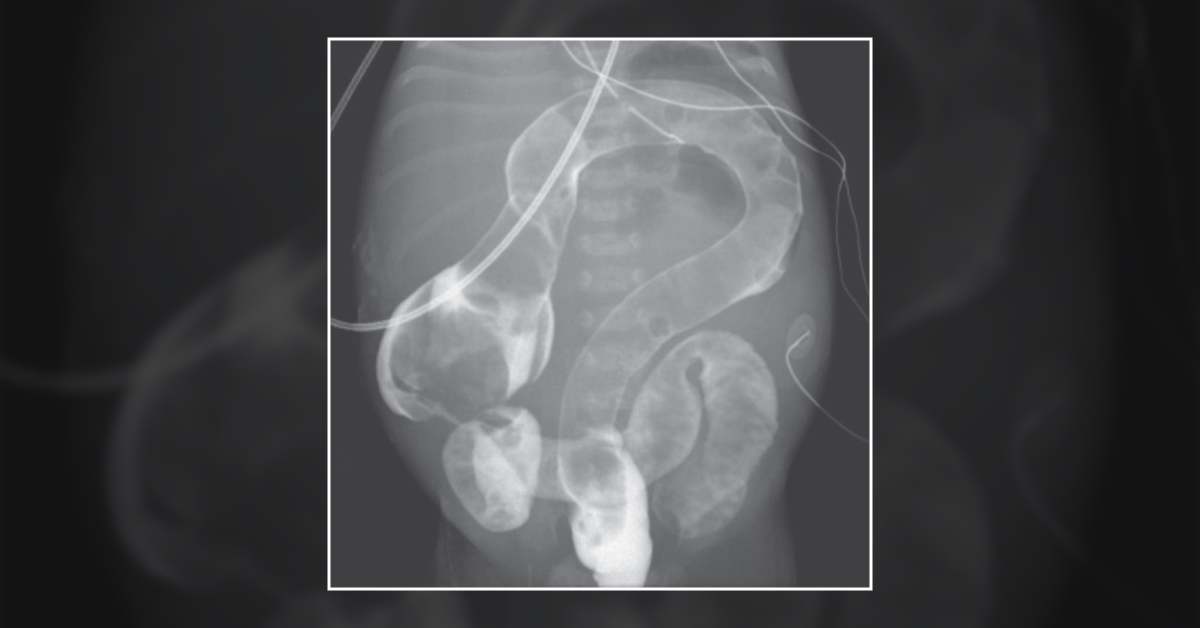 An Infant with Question Mark Appearance of Colon