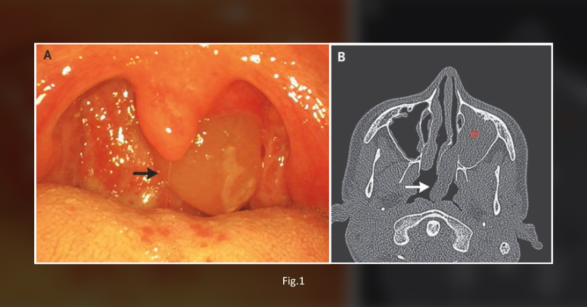 Case of an Accidentally Identified Pharyngeal Mass in a Young Boy