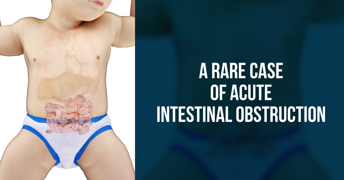 A Rare Case Of Small Bowel Obstruction Due To Anomalous Congenital Bands In Children