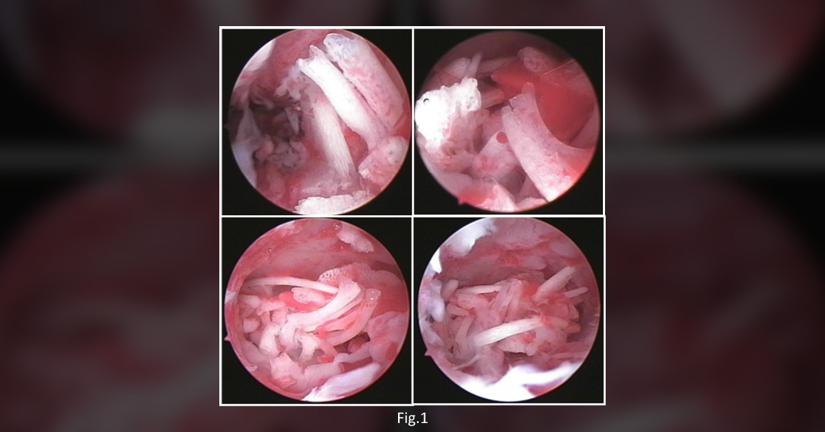 Infertility Instigated By Intrauterine Fetal Bone Retention