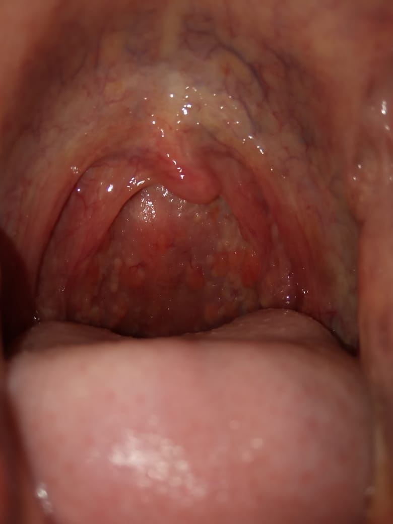 Diagnosis And Treatment For This Throat Irritation