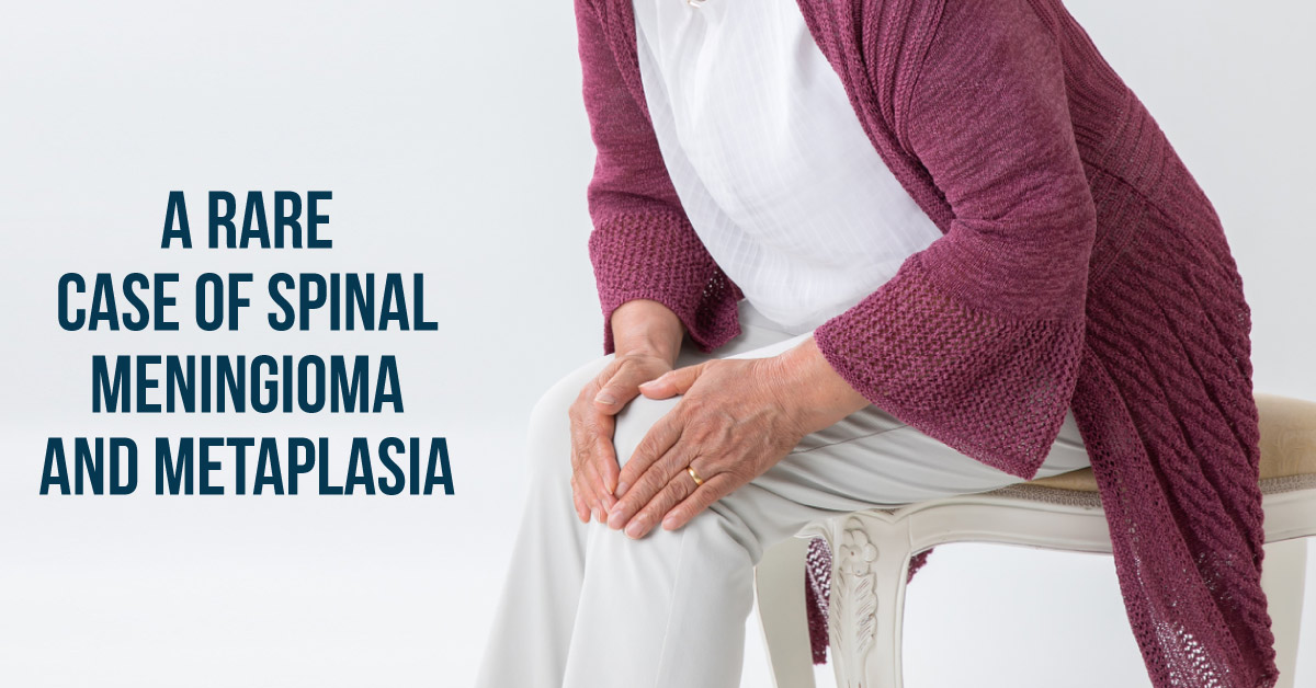 A Rare Case of Spinal Meningioma with Osseous Metaplasia