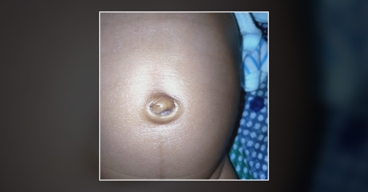 Umblical Lesion?