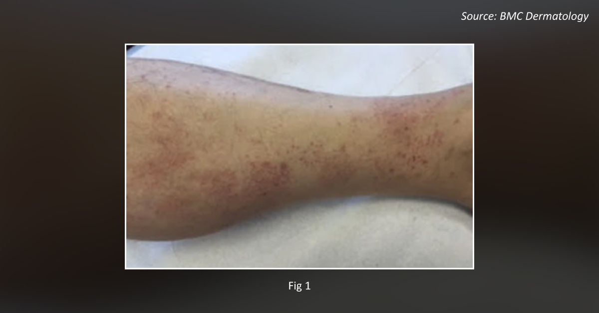 Diagnose This Condition Of Skin Eruptions