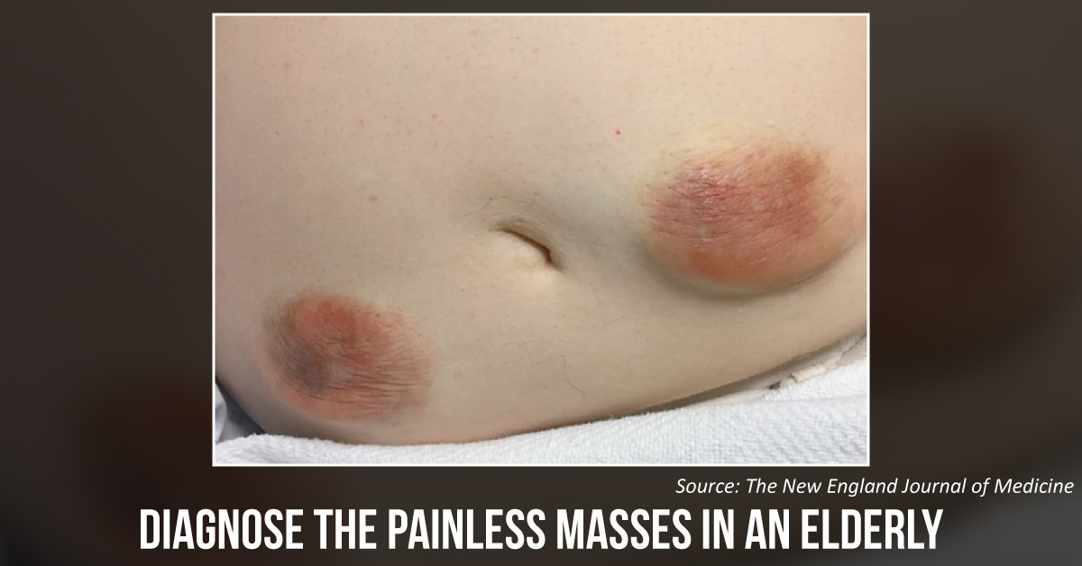 Painless Masses Near The Umbilical Area