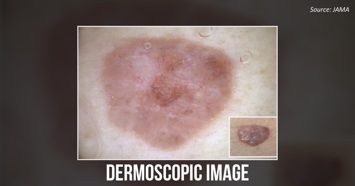 Suggest Suitable Treatment For This Skin Condition