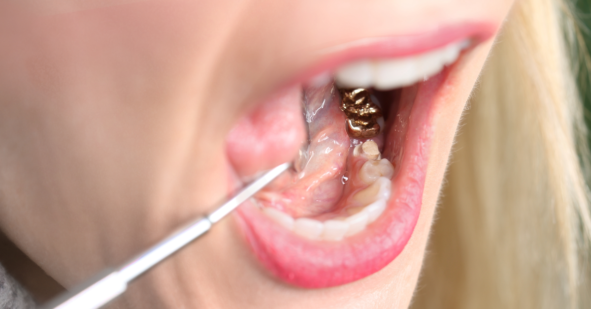 Fading Gold Crowns and Silver Restorations