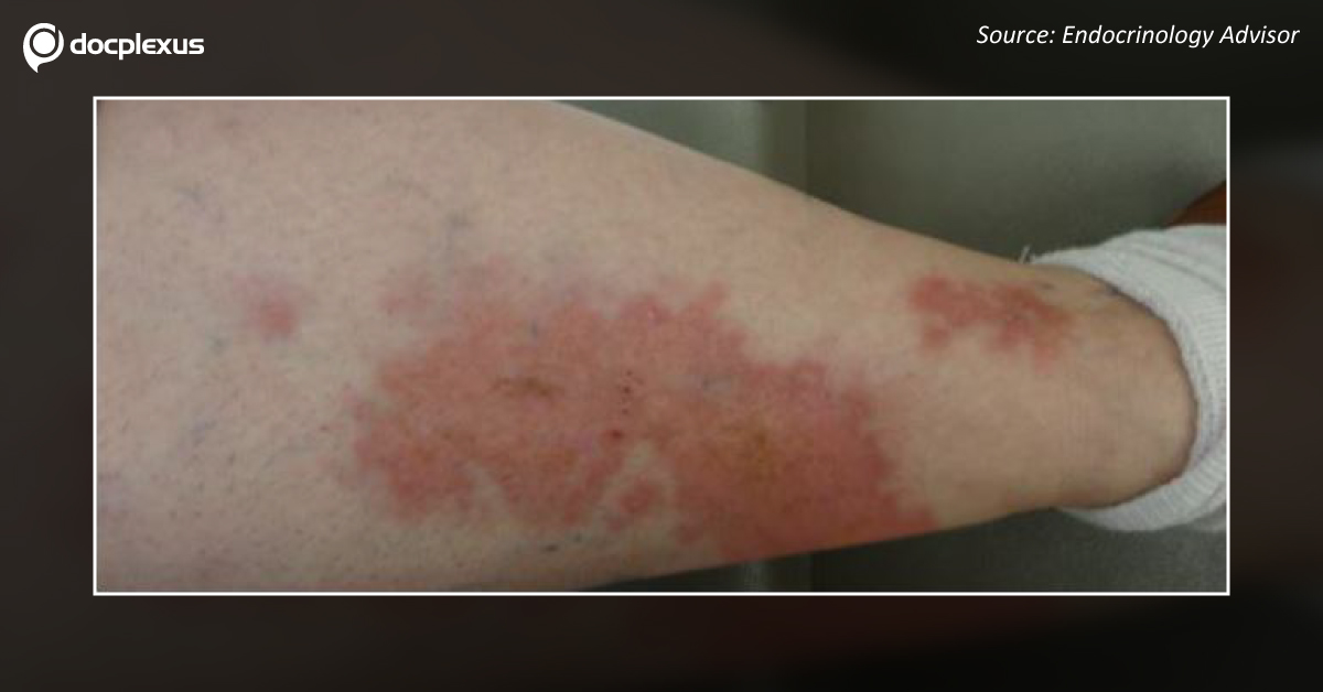 Diagnose The Erythematous Rash On The Lower Limbs