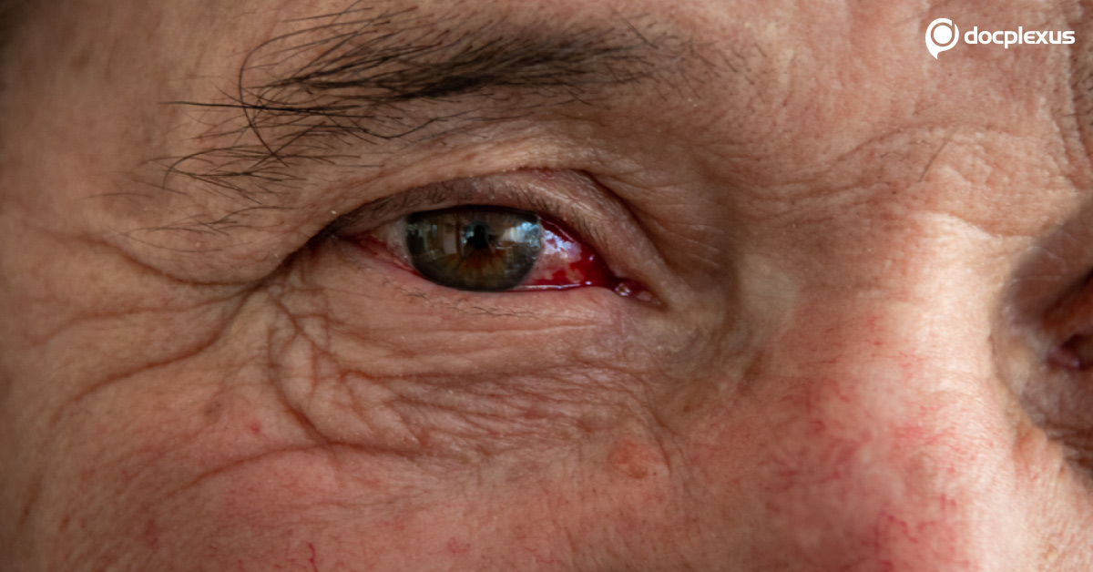Identify The Pathogen In This Case Of Microbial Conjunctivitis