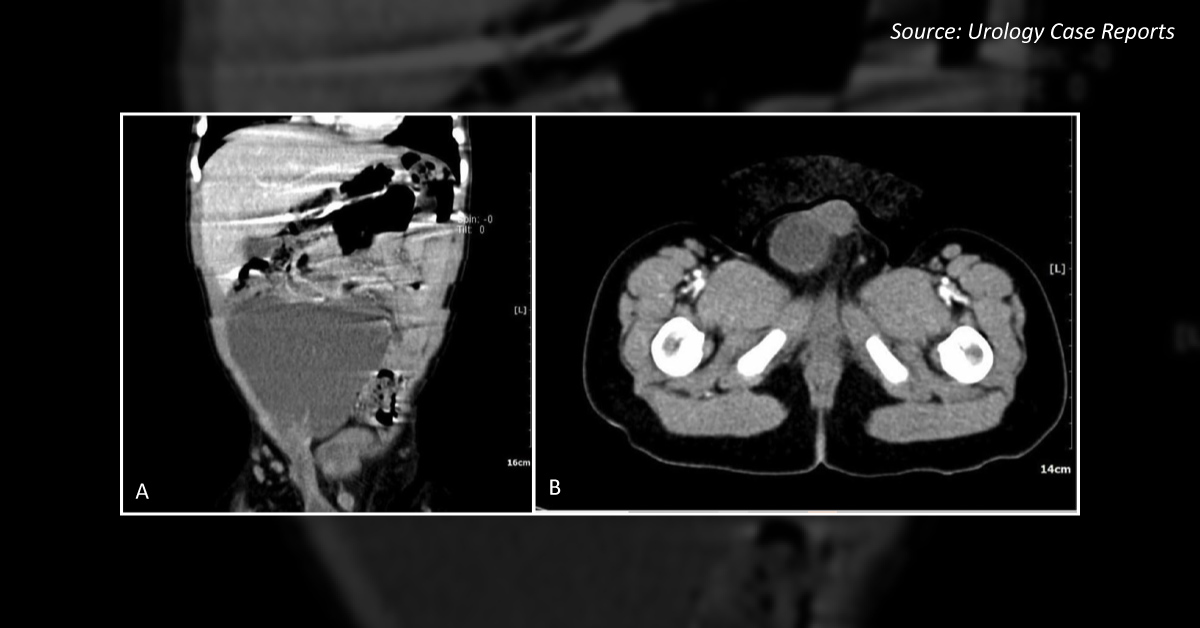Urological Complications due to a Large Abdominal Cyst