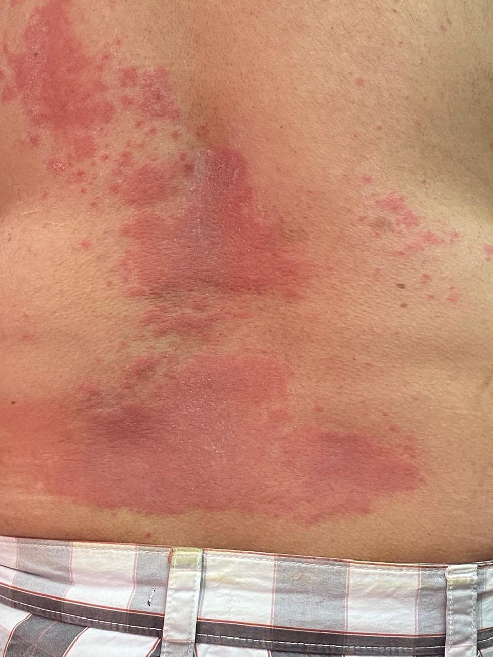 Spot The Diagnosis Of Maculo-papular Rash With Severe Itching