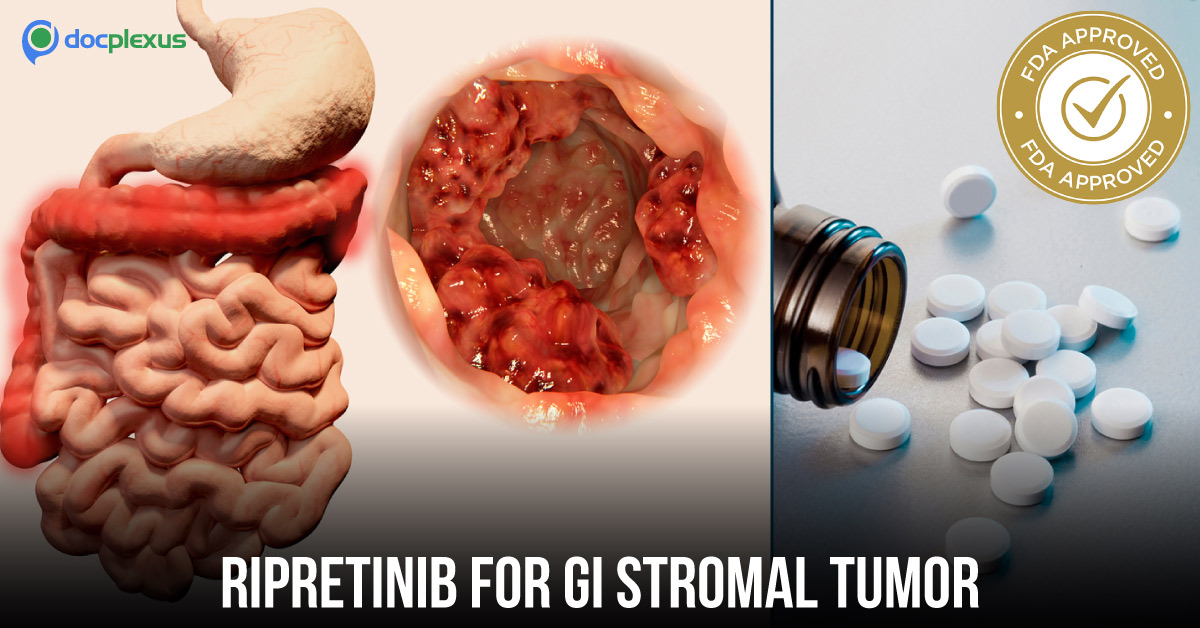 FDA Approves Ripretinib For Gastrointestinal Stromal Tumors