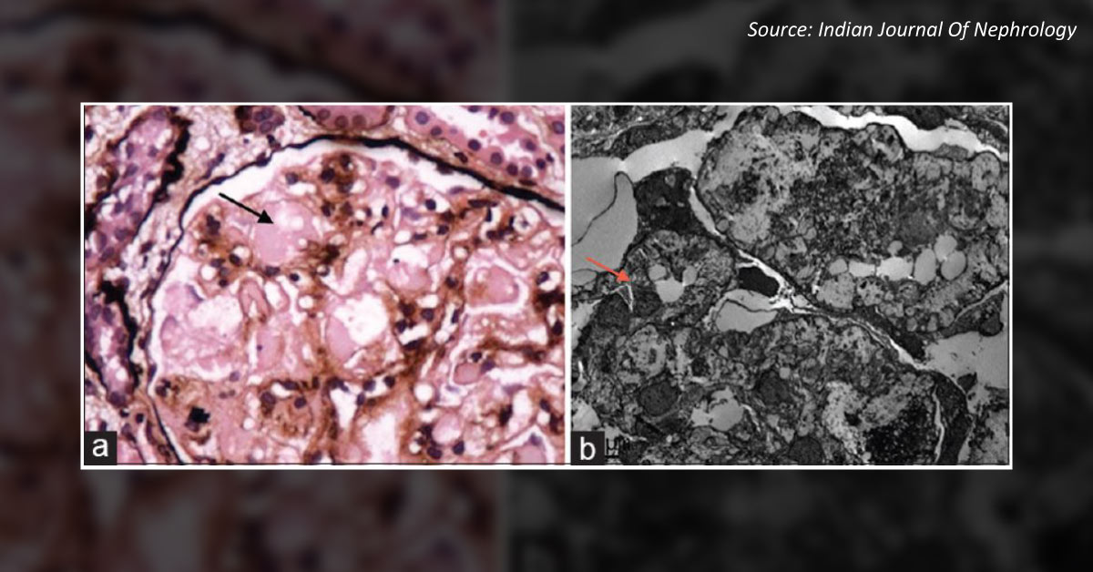 An Unusual Presentation Of Nephrotic syndrome