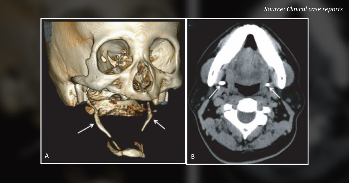 Unusual Case of Dysphagia in a Patient With Chronic Orofacial Pain