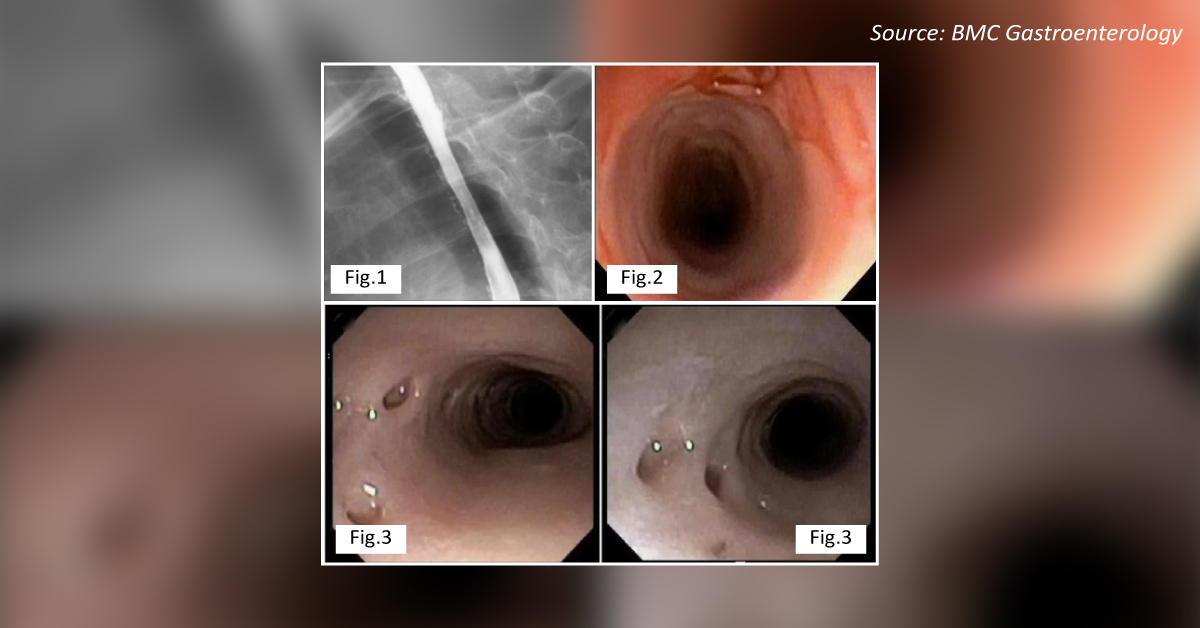 What's Causing Dysphagia in This Patient with Liver Cirrhosis, Chronic Pancreatitis and GERD?