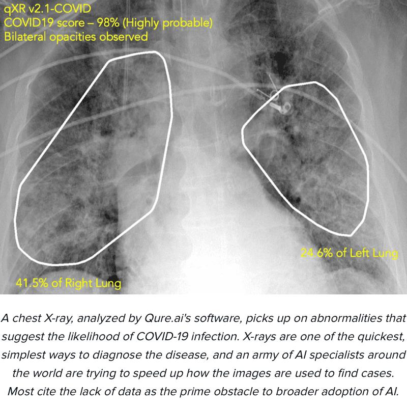 Chest X ray showing COVID-19 infection