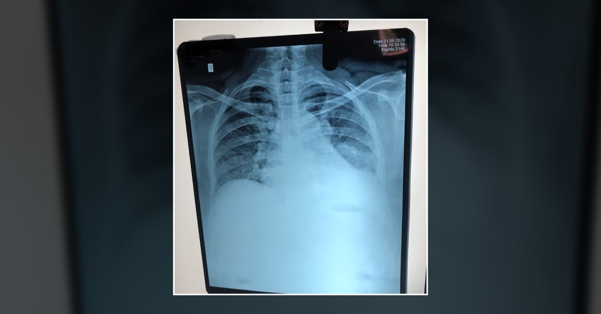 Patient With Severe Body Pain