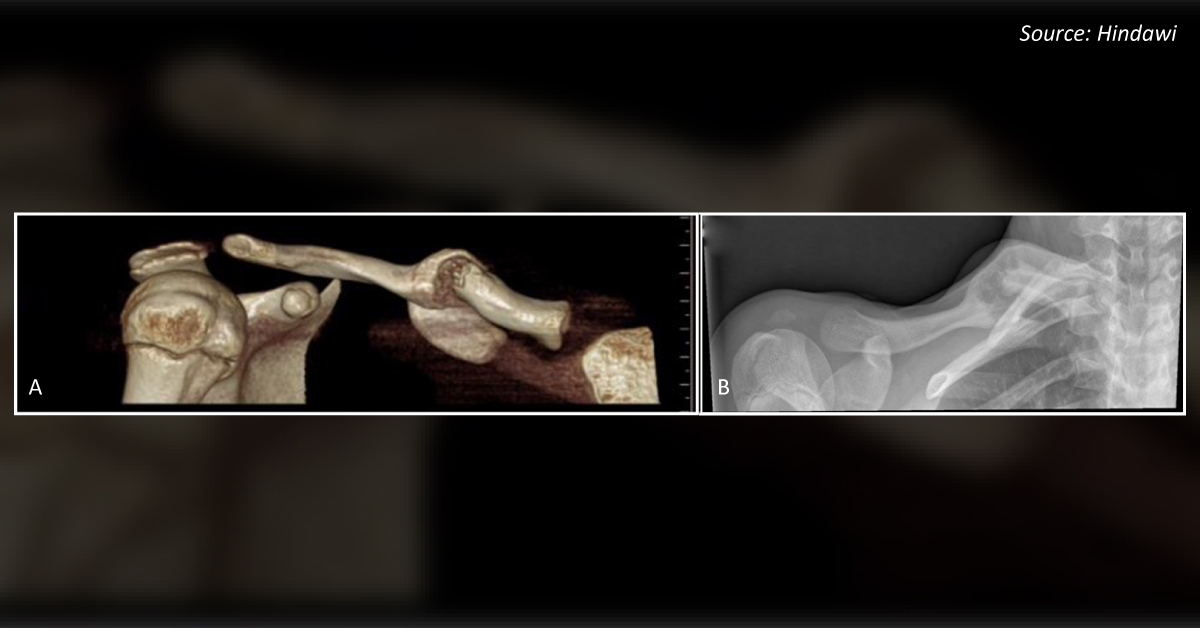 A Junior Javelin Thrower with Severe Shoulder Pain