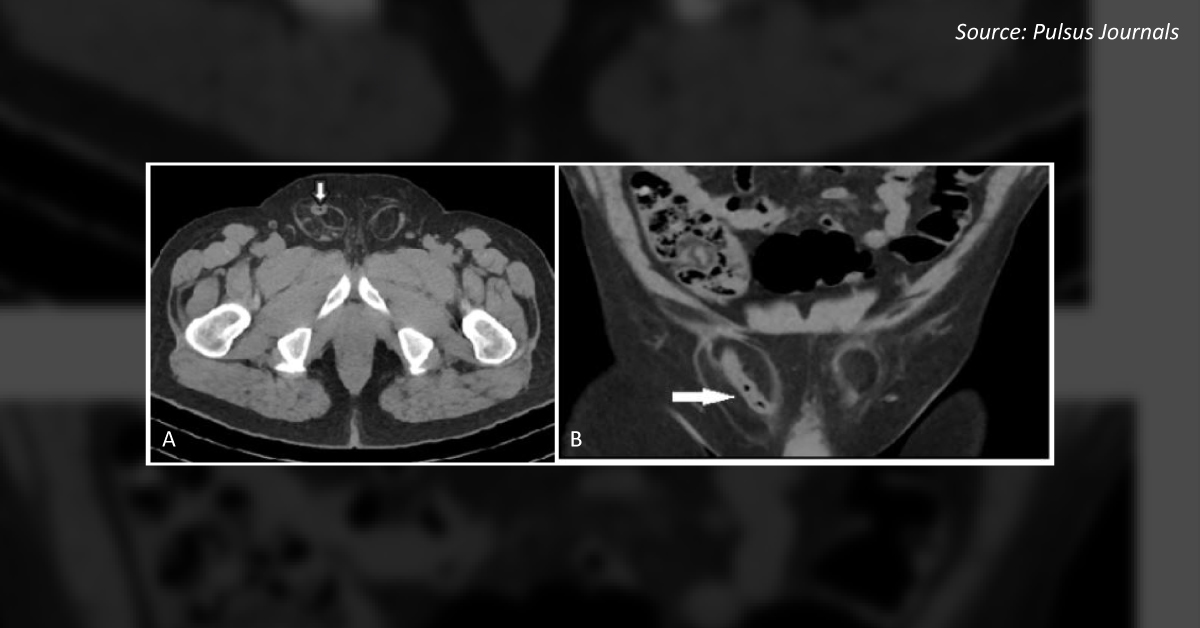 An Unusual Presentation of Inguinal Hernia