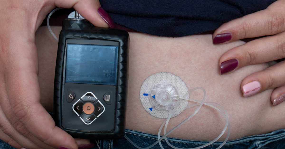 Unusual Presentation Of T1DM In A Female Patient