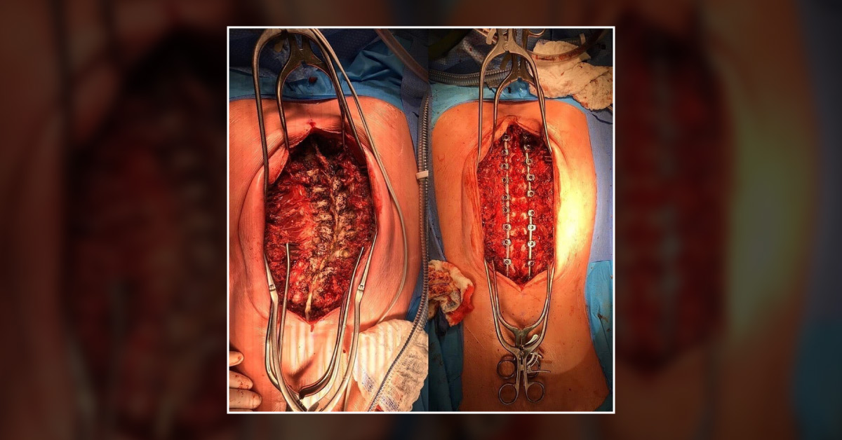 Case Of Scoliosis
