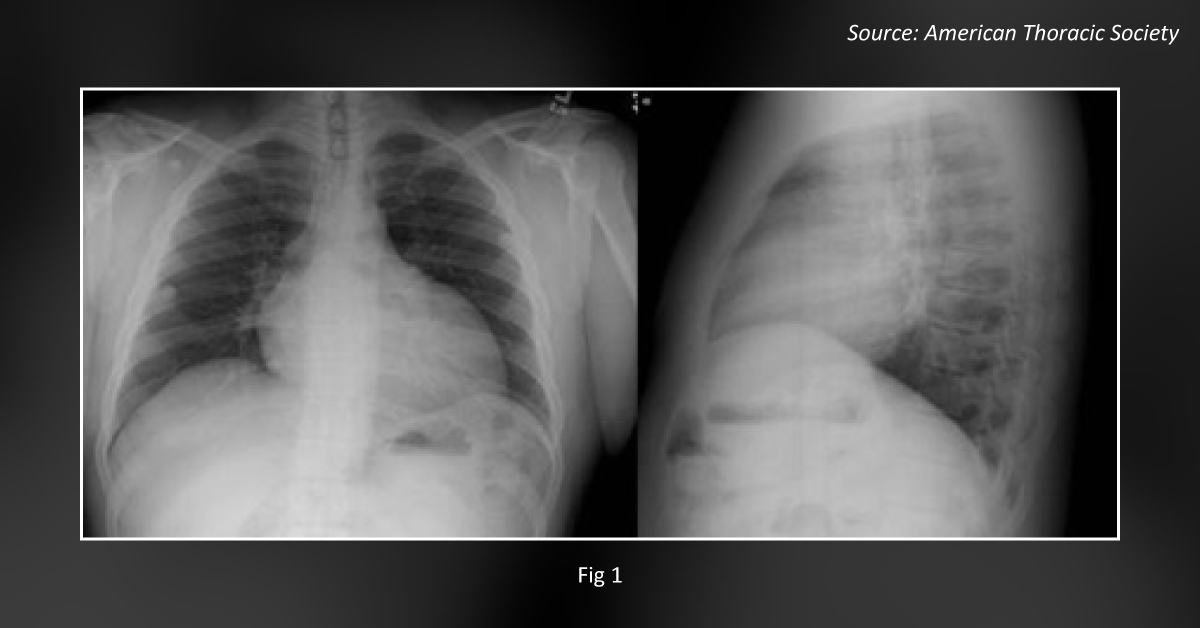 Can You Interpret the Chest Radiograph and Diagnose the Case?