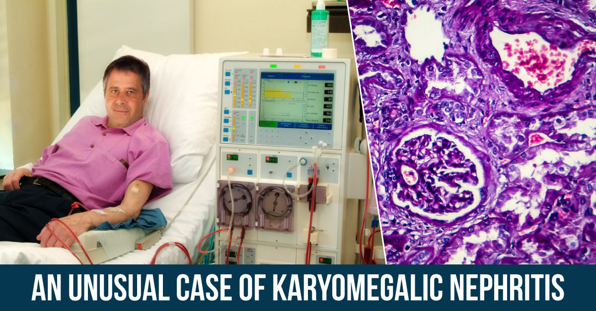 An Uncommon Case Of Karyomegalic Nephritis