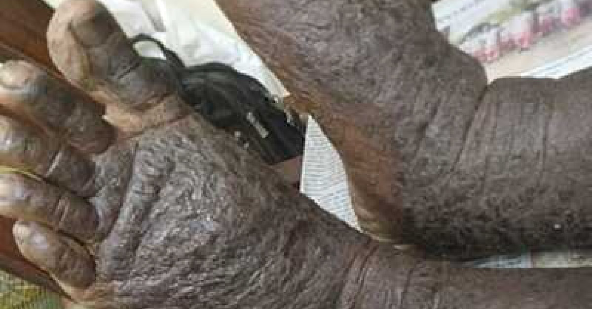 Skin Rash In An Asthmatic Patient