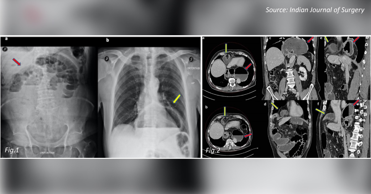 Diagnose This Case of Acute Abdominal Pain
