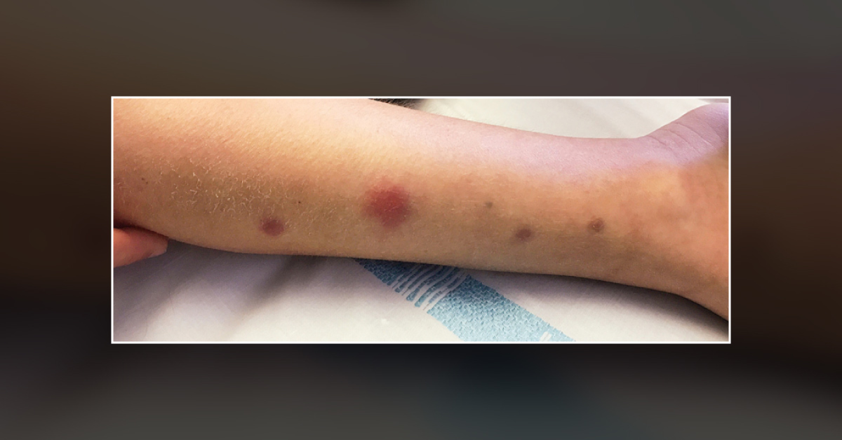 A Boy with Unexplained Lesions