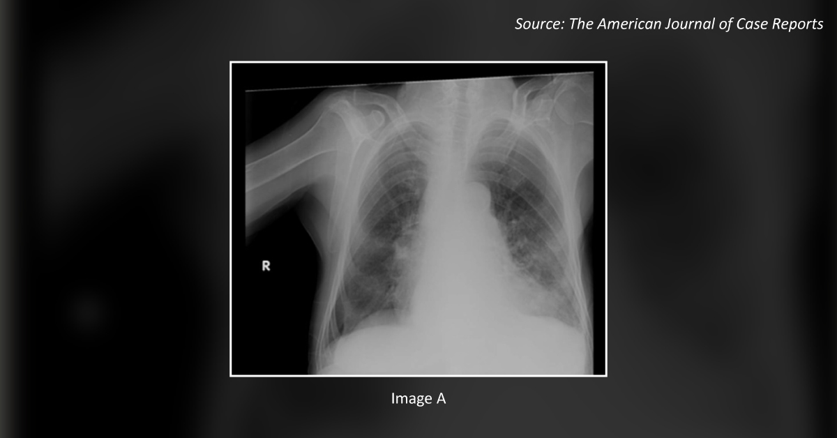 Acute Renal Failure In An Elderly Woman With Chronic Lymphocytic Leukemia