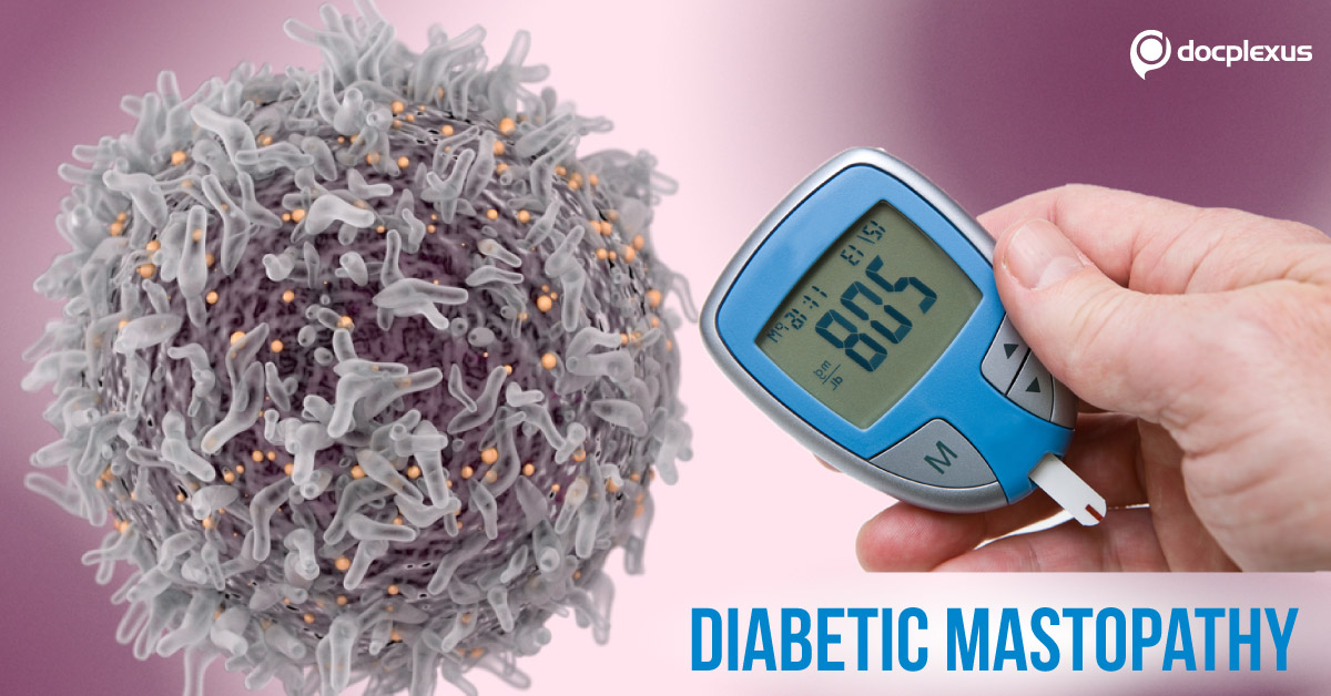 Diabetic Mastopathy: An Entity that Mimicks Malignancy