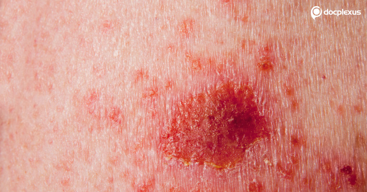 Mohs Micrographic Surgery For The Treatment Of  Non-melanoma Skin Cancer