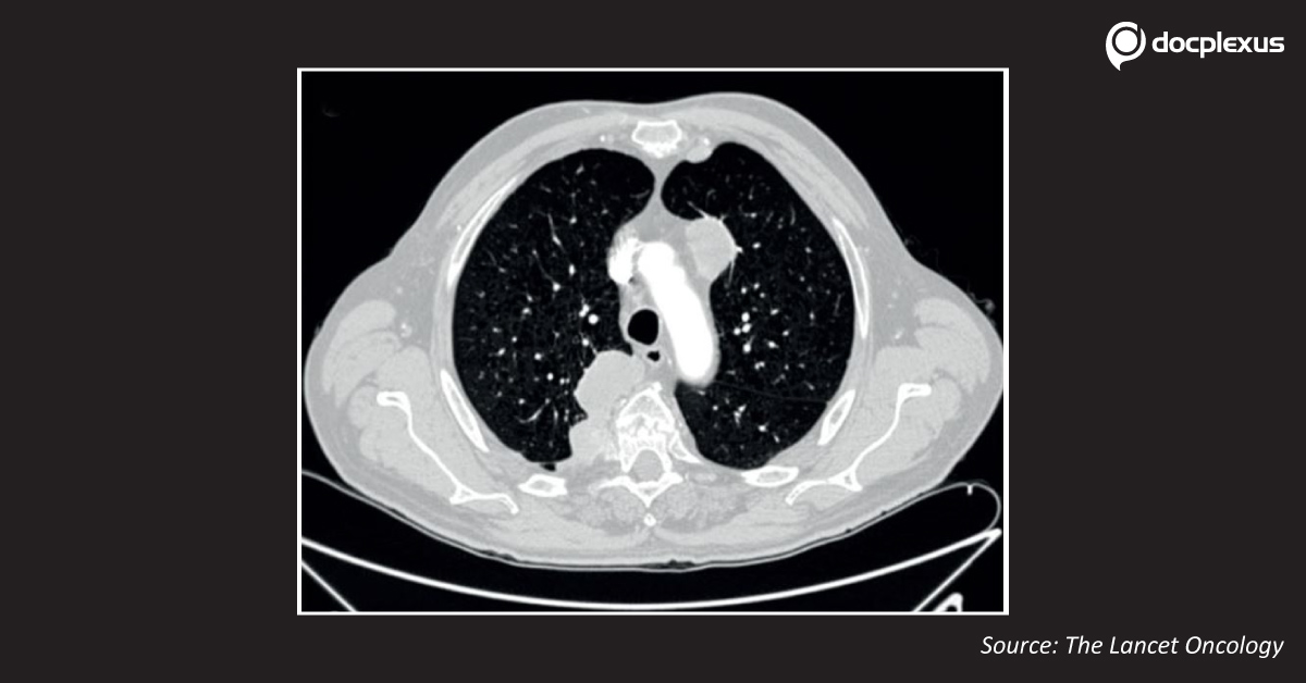 Decipher The Cause Of Pneumothorax In The Cancer Patient