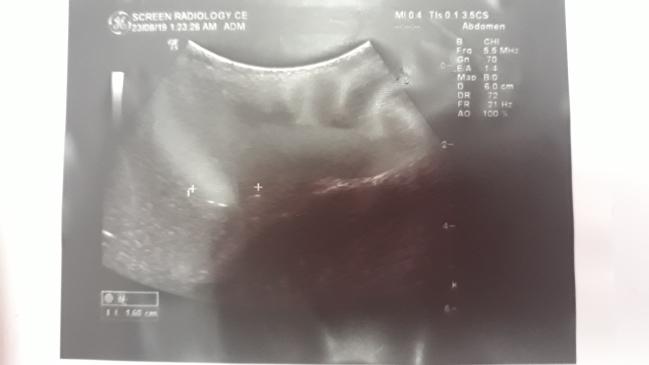 Case Of Child Suffering From LUQ Pain