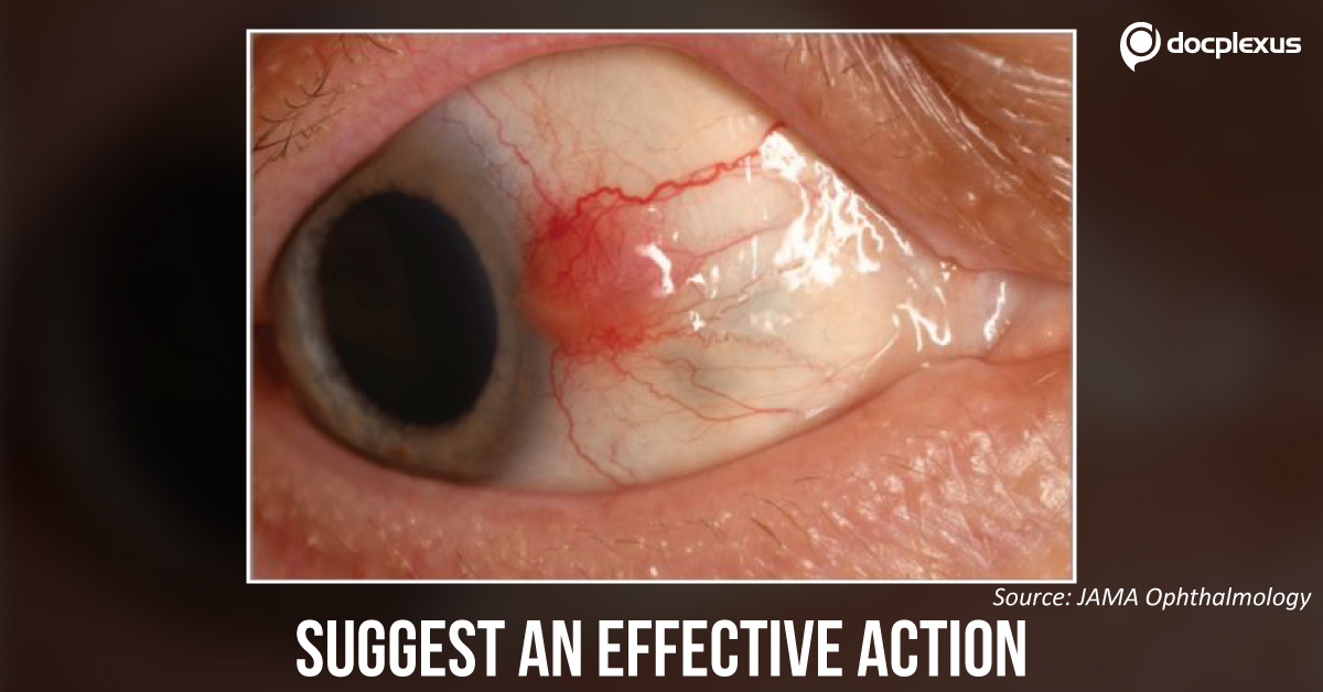An Elderly Man With Rapidly Enlarging Conjunctival Lesion